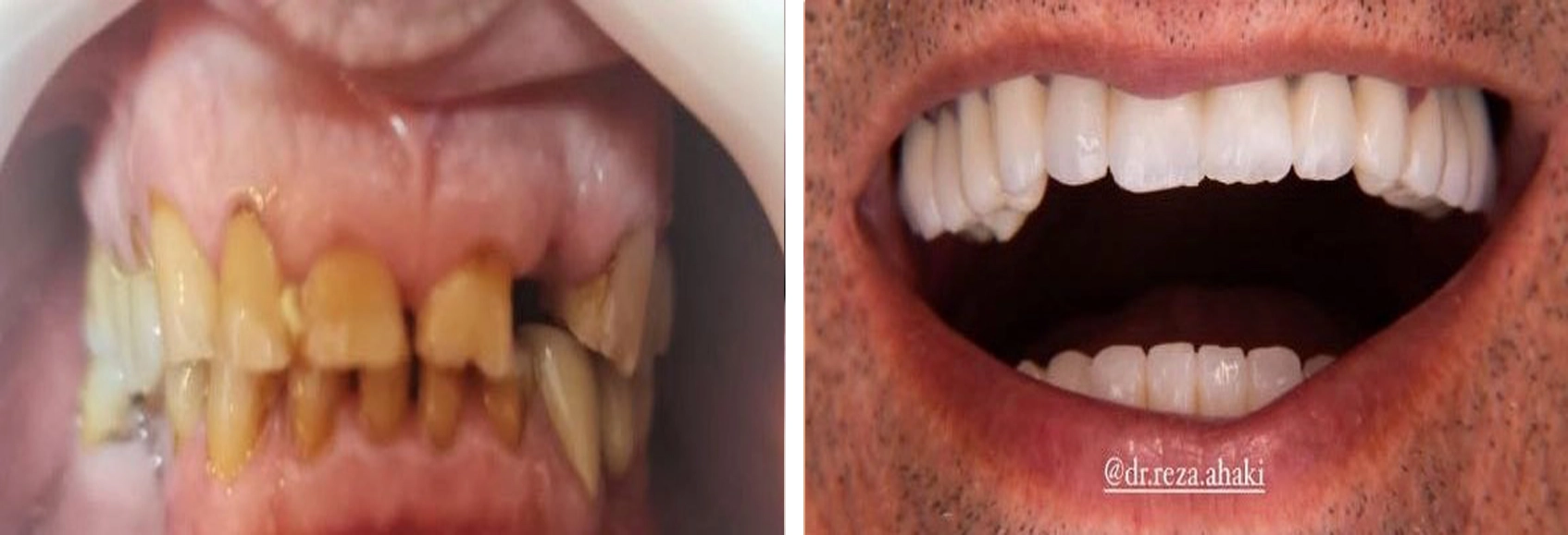 روکش دندان نمونه 6