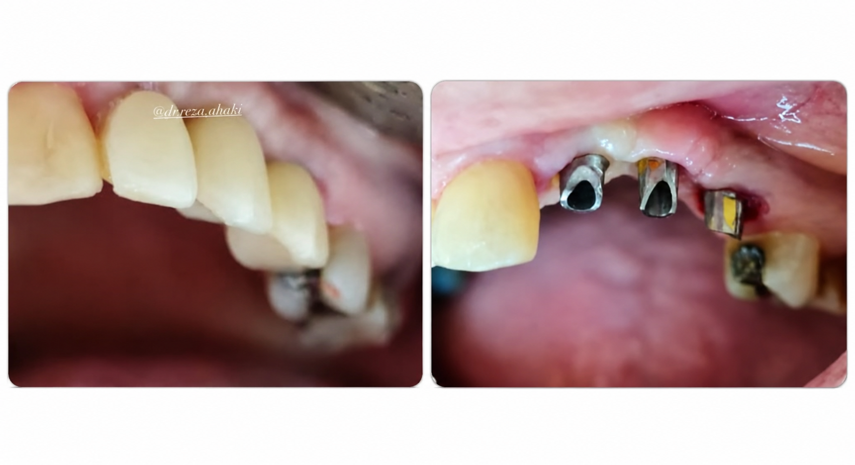 ایمپلنت دیجیتال نمونه 6