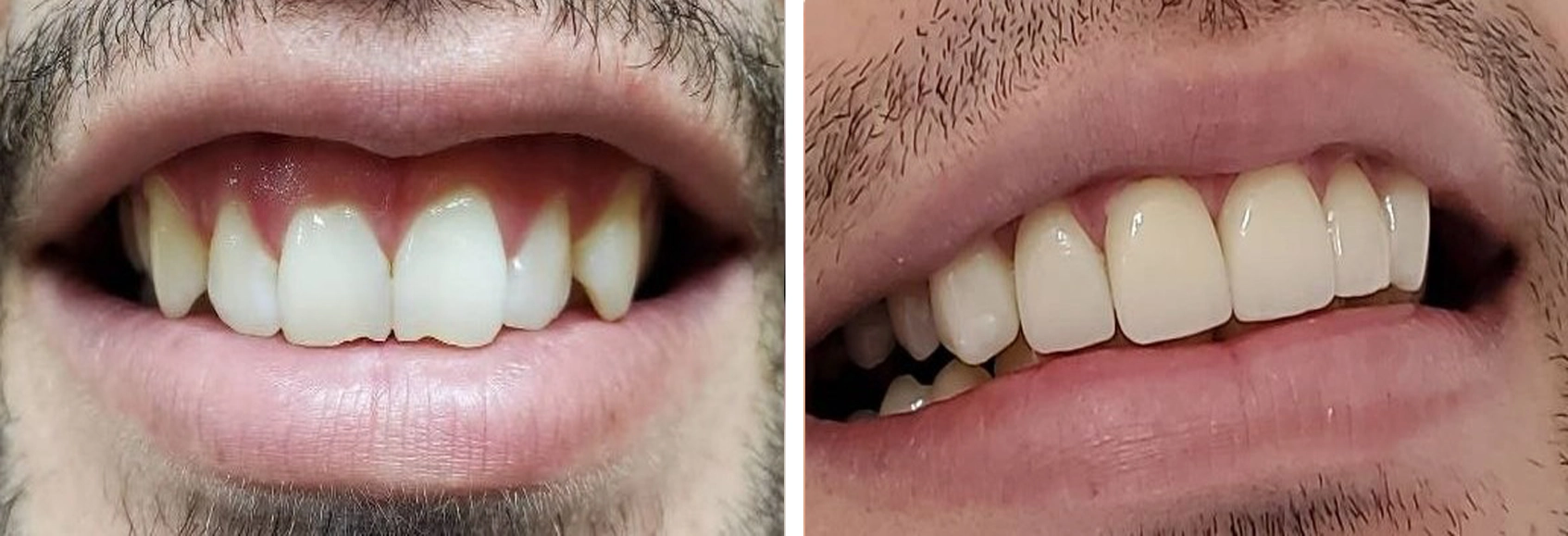 لمینت نمونه 1